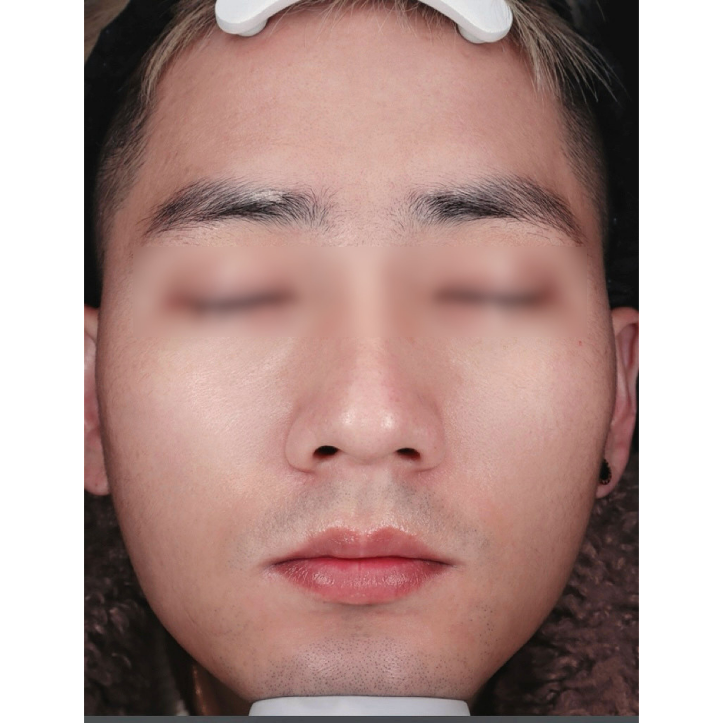 After — Beatrice Meso clinical case: full face