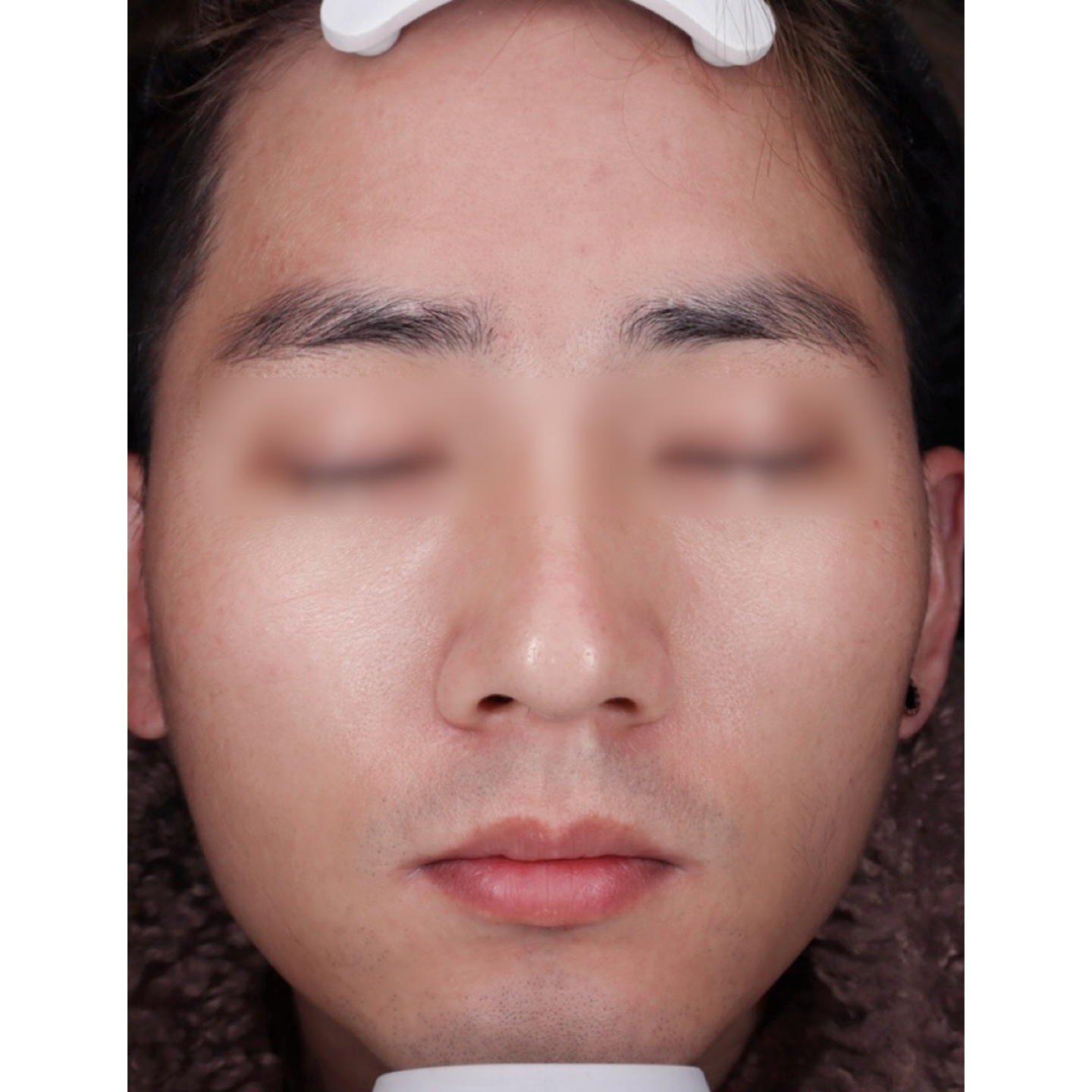 Before — Beatrice Meso clinical case: full face