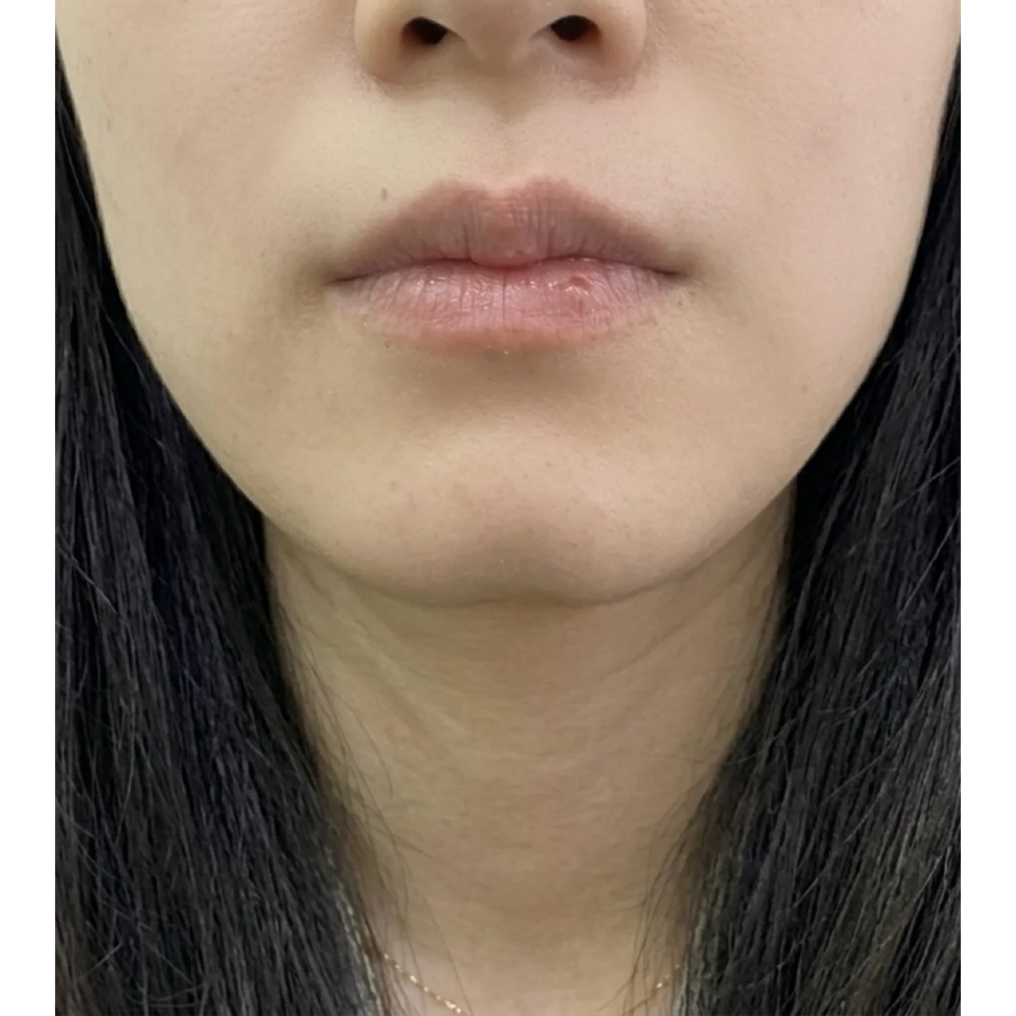 Before — Case A — Chin