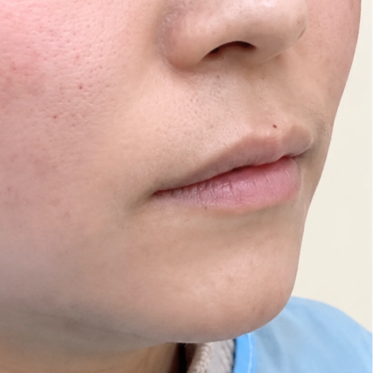 Before — Lip Fullness — Lip