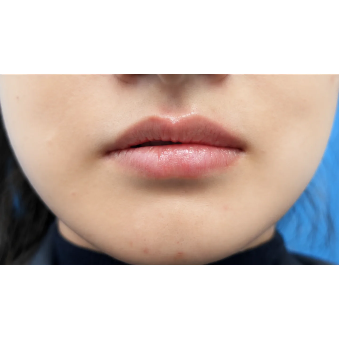 After — Lip Lines — Lip