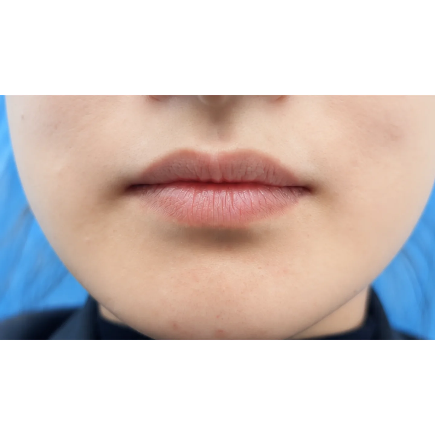 Before — Lip Lines — Lip