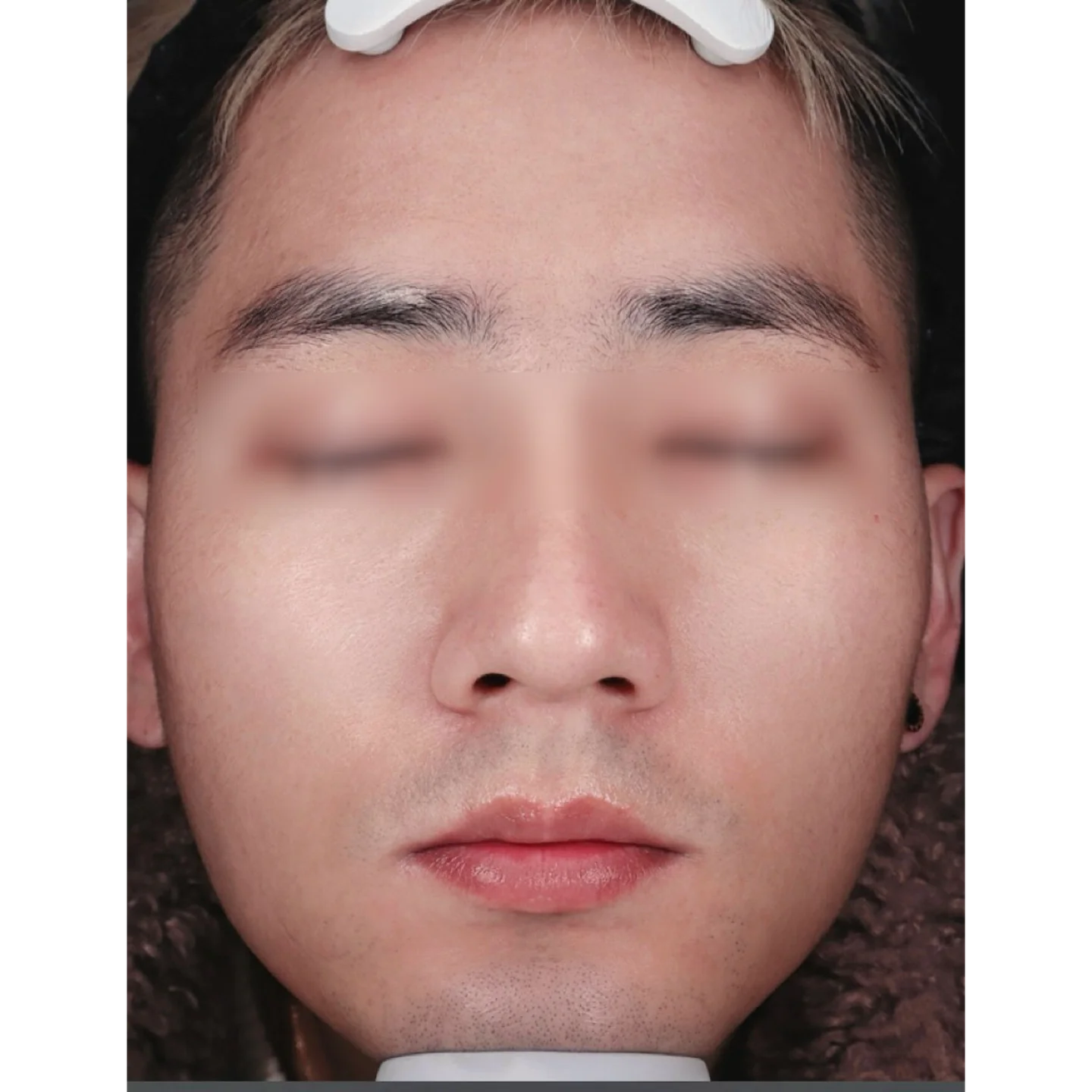 After — Case A — Mesoderm