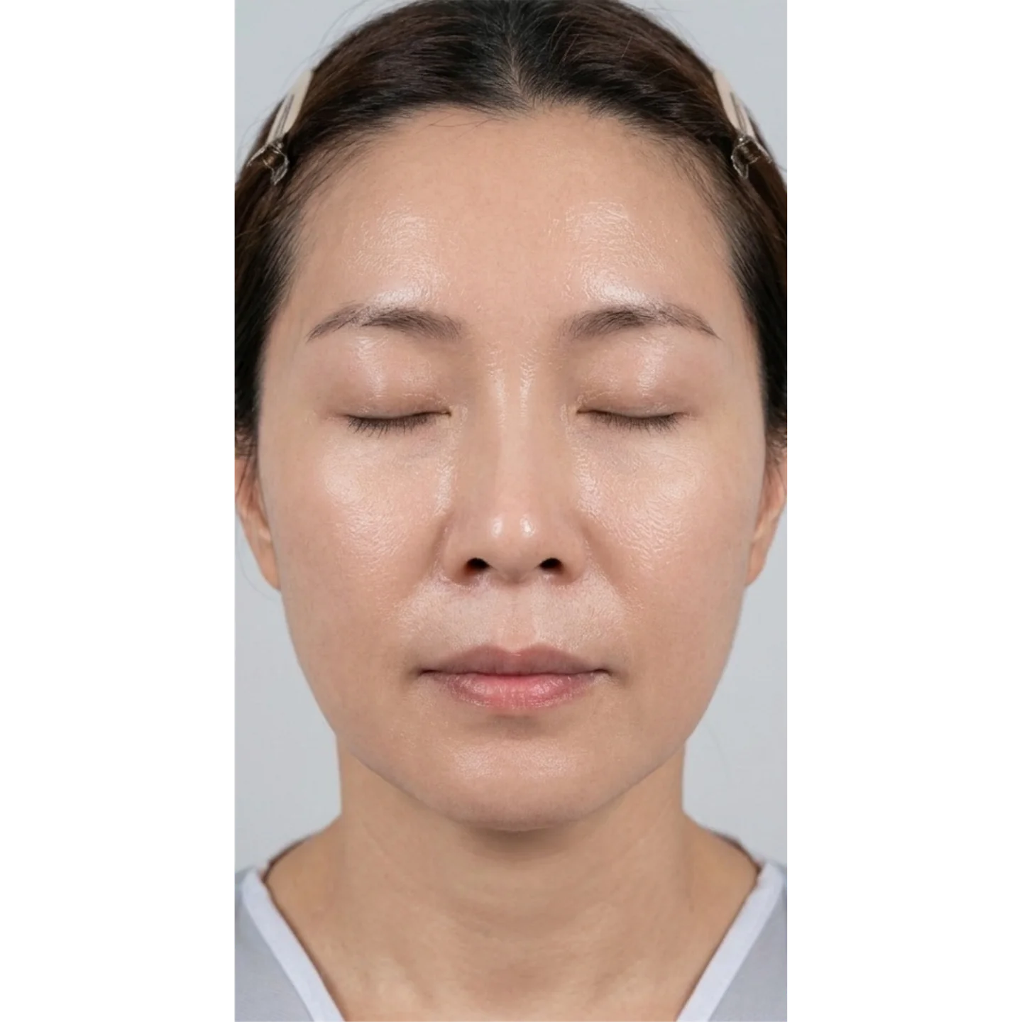 After — Case B — Mesoderm