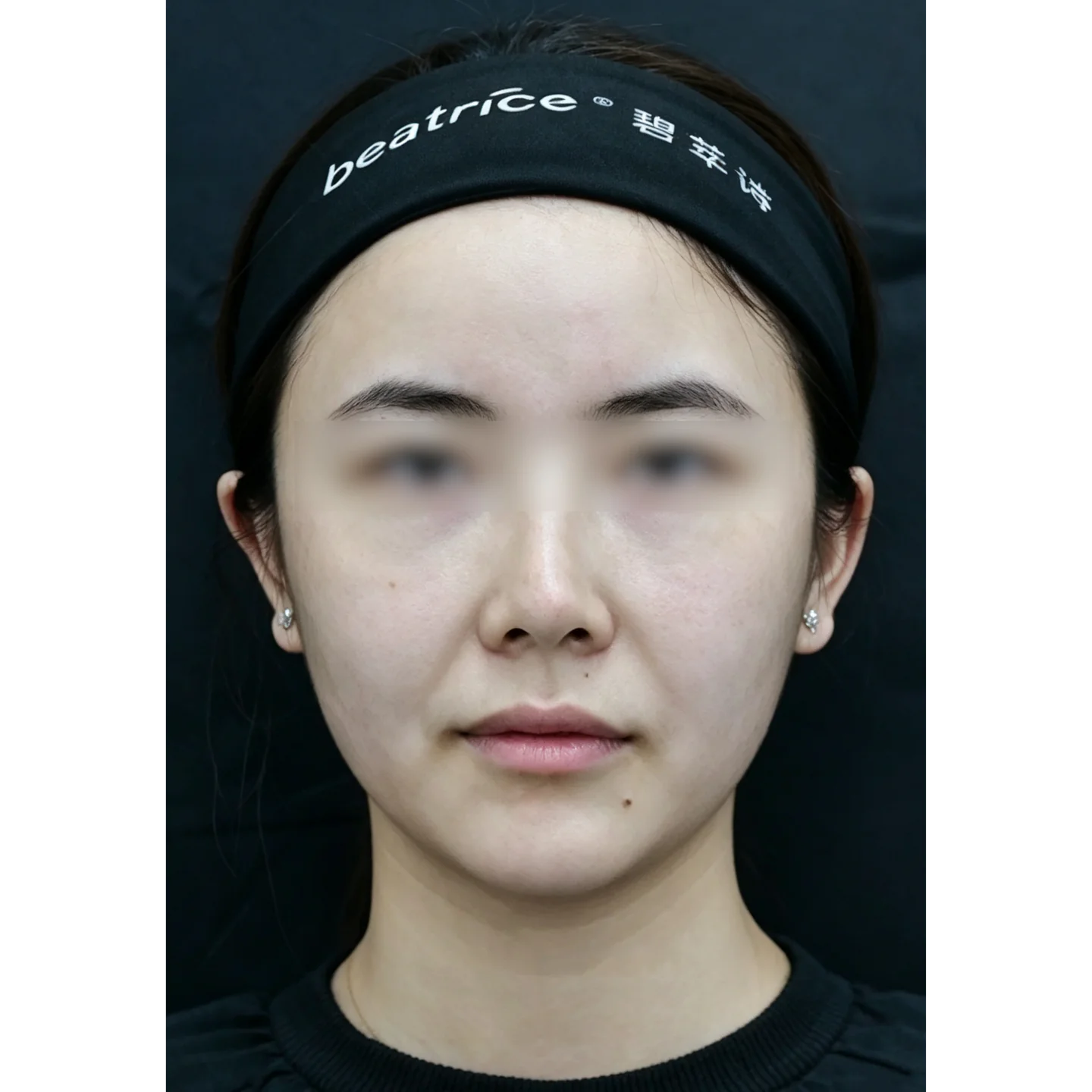 Before — Nasolabial folds and marionette lines treatment case