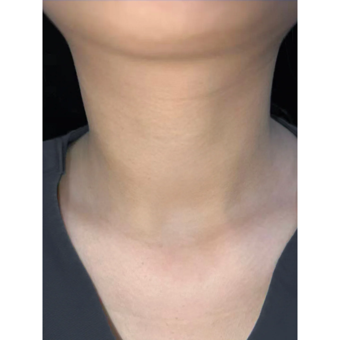 After — Case B — Neck